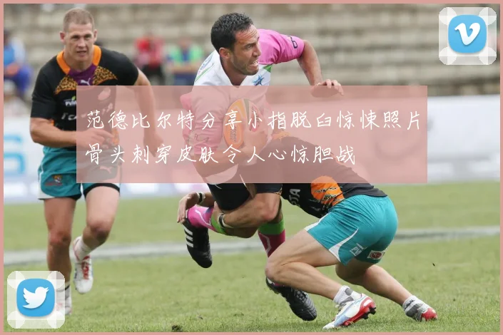 范德比尔特分享小指脱臼惊悚照片骨头刺穿皮肤令人心惊胆战